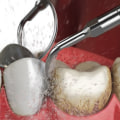 What Tools Do Dental Hygienists Use to Keep Your Teeth Healthy?