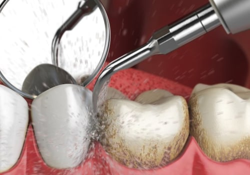 What Tools Do Dental Hygienists Use to Keep Your Teeth Healthy?